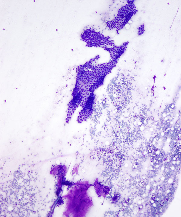 image showing 'Fibroadenoma'