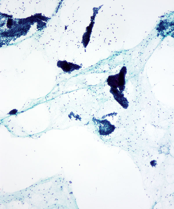 2 : Breast Fibroadenoma