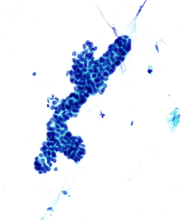 3 : Breast Fibroadenoma