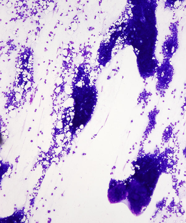 image showing 'Fibroepithelial Lesion'