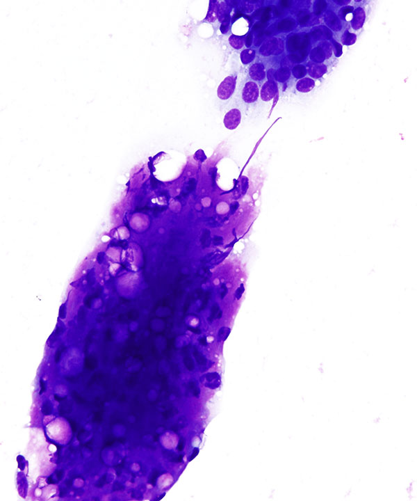 03 : Breast Fibroepithelial Lesion