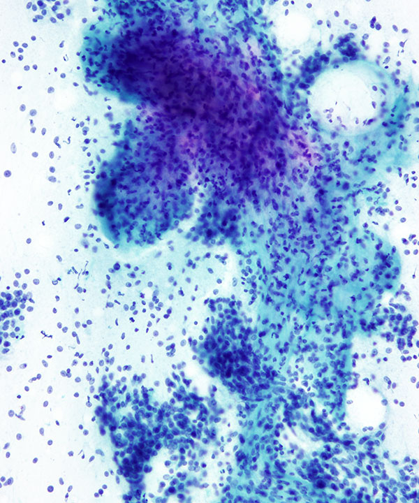 07 : Breast Fibroepithelial Lesion