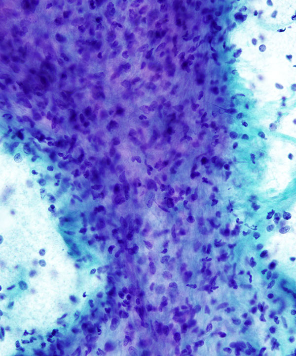 09 : Breast Fibroepithelial Lesion