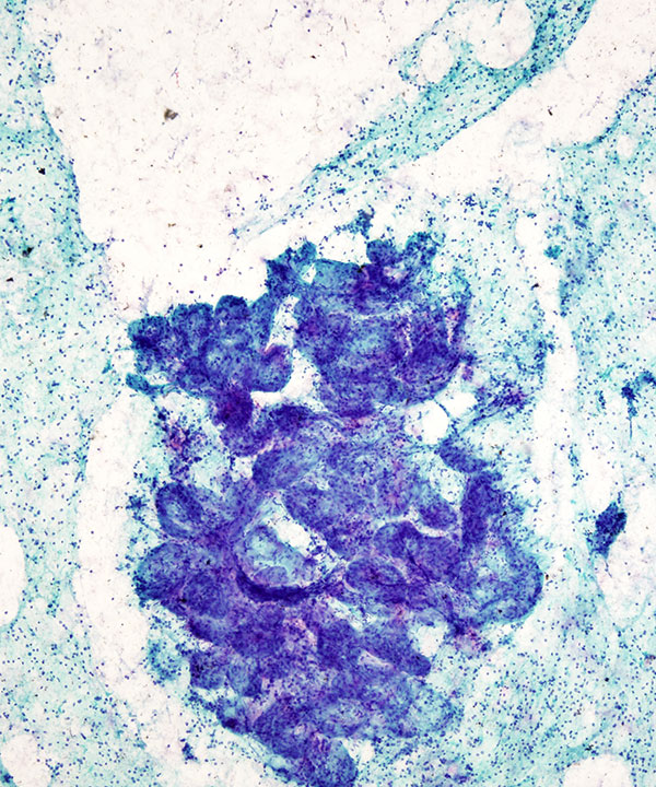 04 : Breast Lactational Adenoma