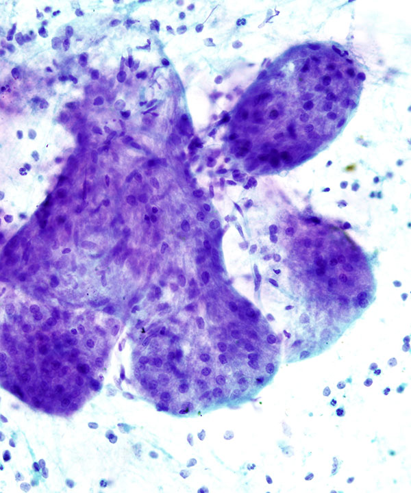 05 : Breast Lactational Adenoma