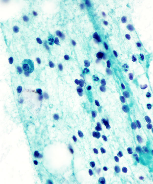 06 : Breast Lactational Adenoma