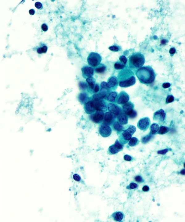 3 : Breast Lobular Carcinoma