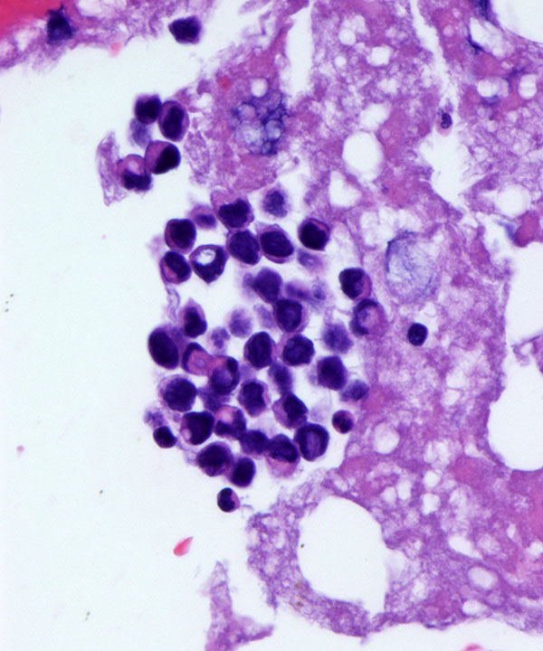 6 : Breast Lobular Carcinoma