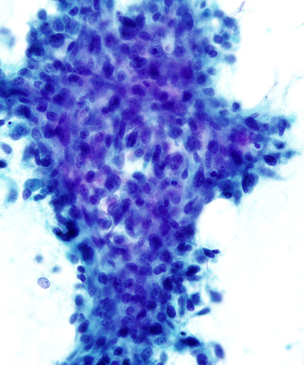 image showing 'Metaplastic Carcinoma'