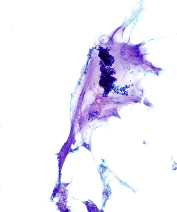 03 : Breast Mucinous Carcinoma