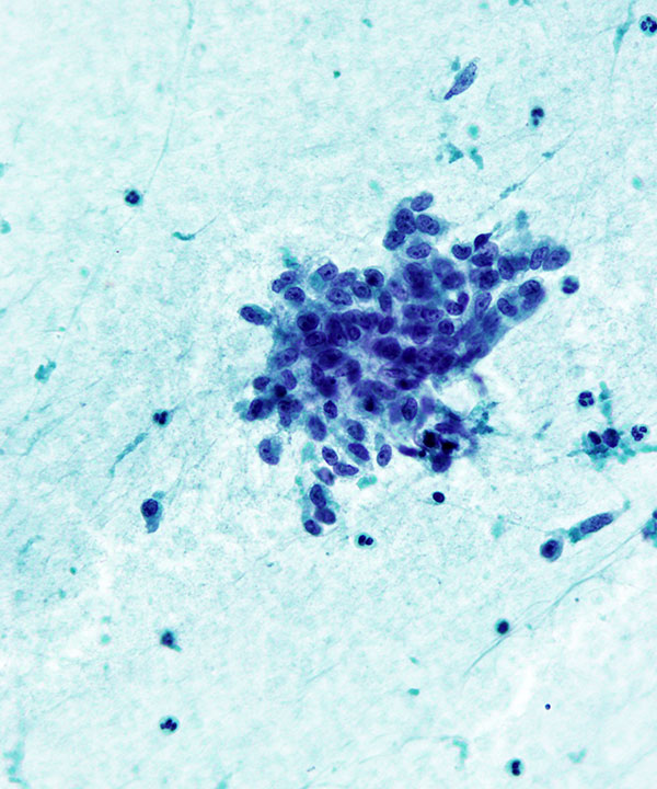 image showing 'Phyllodes Tumor'
