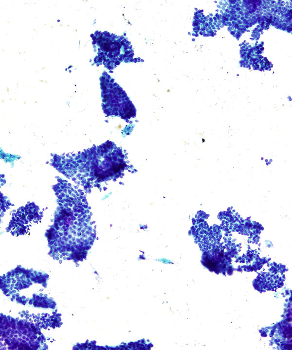 03 : Breast Tubular Carcinoma