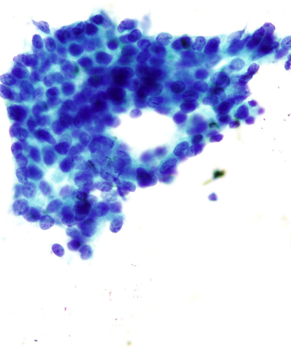 06 : Breast Tubular Carcinoma