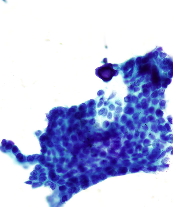 07 : Breast Tubular Carcinoma