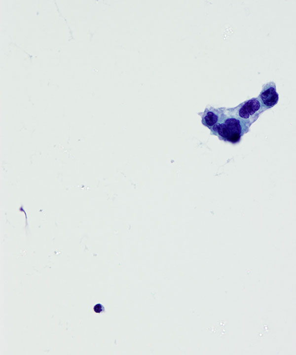 image showing 'CSF Glioblastoma'