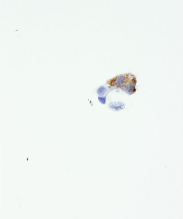 03 : CSF Glioblastoma