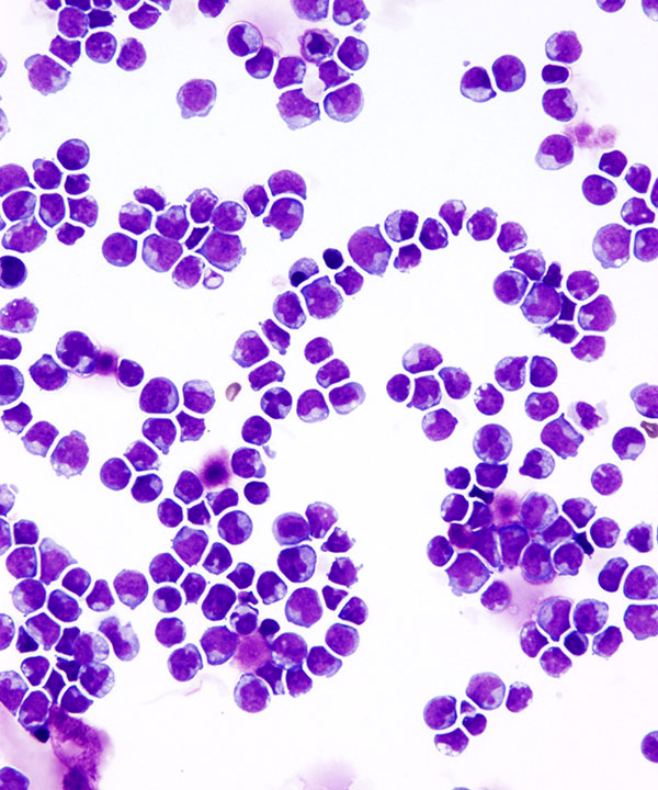 image showing 'CSF Leukemia'