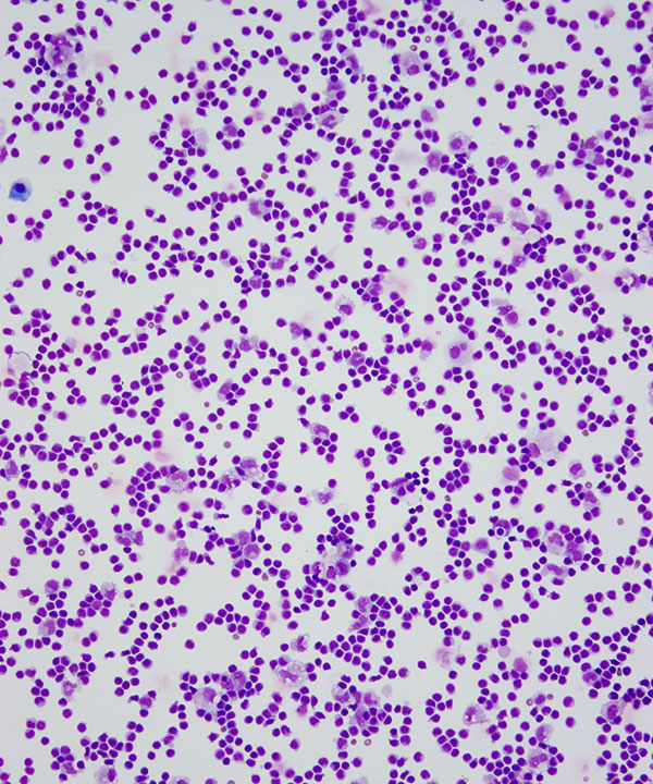 image showing 'Lymphocytosis'