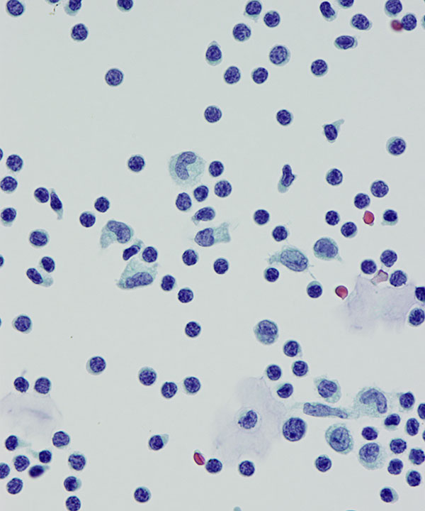 04 : CSF Lymphocytosis
