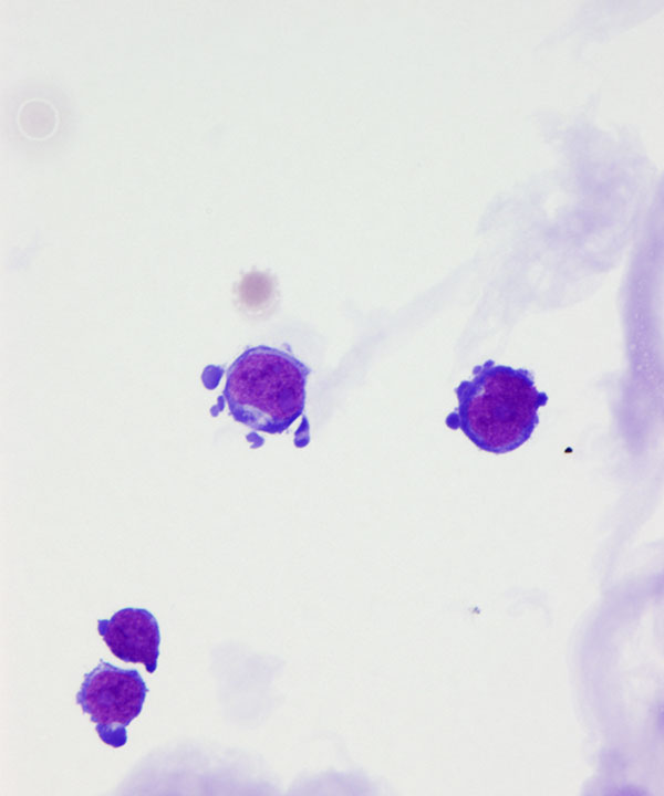 image showing 'CSF Lymphoma'