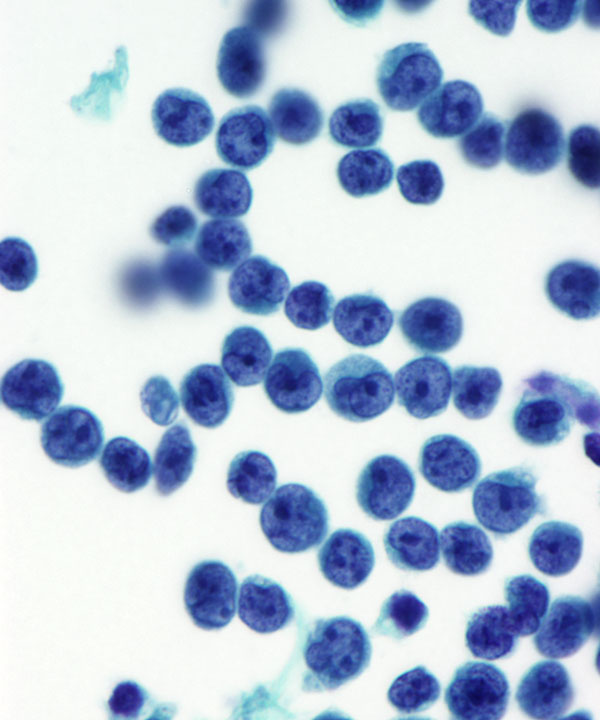 03 : CSF Lymphoma