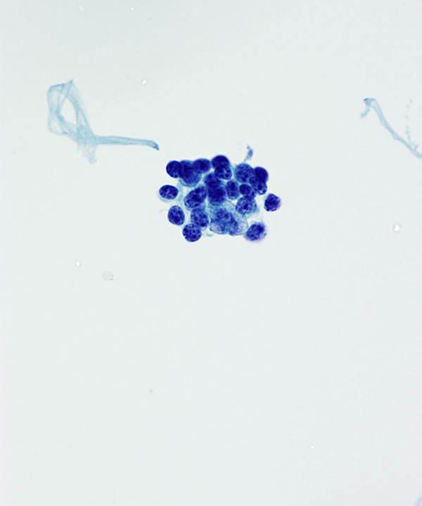 image showing 'CSF Medulloblastoma'