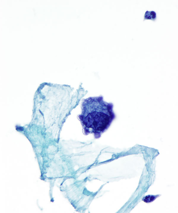 04 : CSF Metastatic Lung Carcinoma