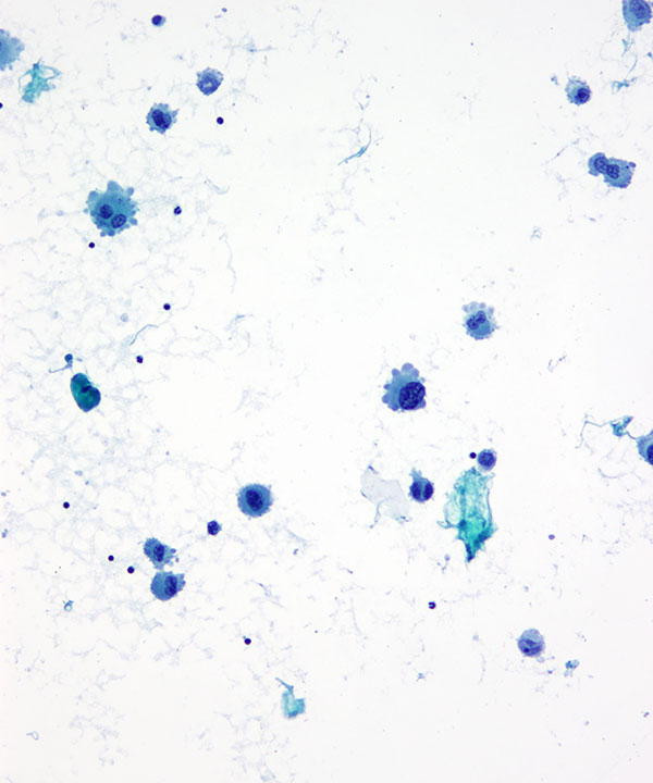 image showing 'CSF Metastatic Melanoma'