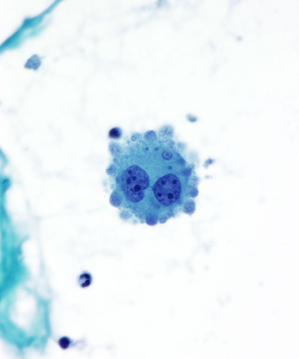 02 : CSF Metastatic Melanoma