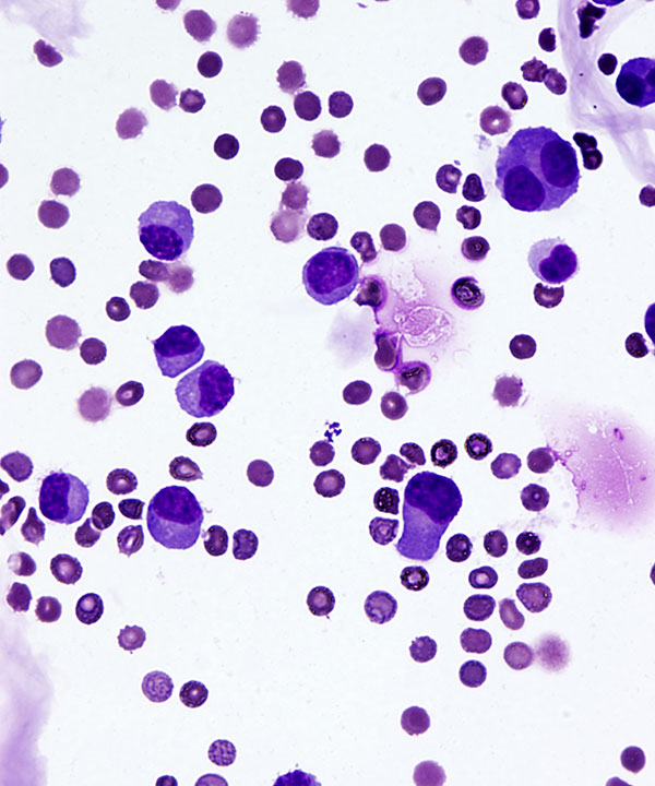 02 : CSF Myeloma