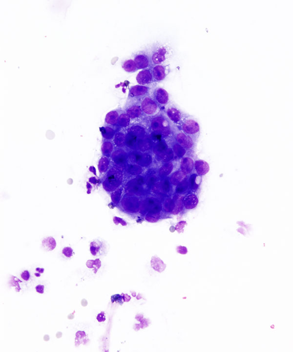 04 : Fluids Metastatic Breast Carcinoma