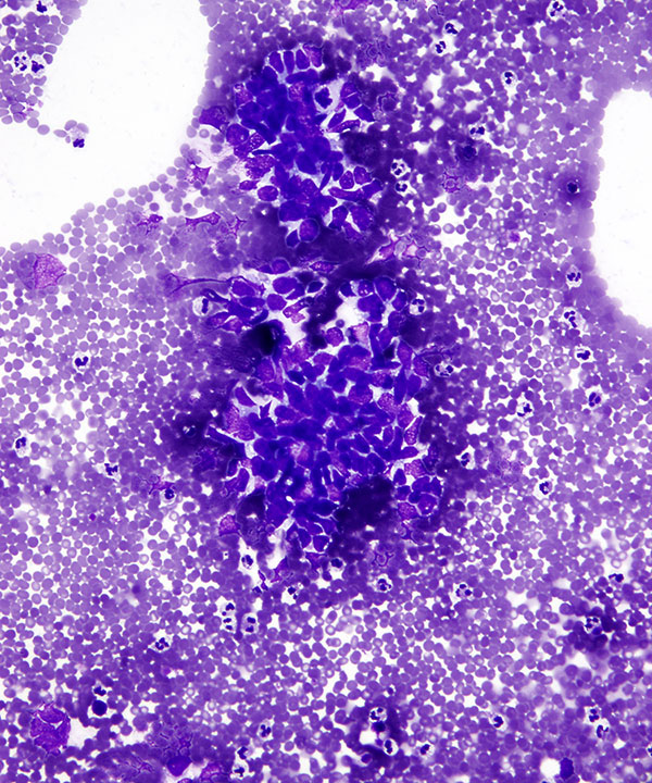 image showing 'Metastatic Small Cell Carcinoma'