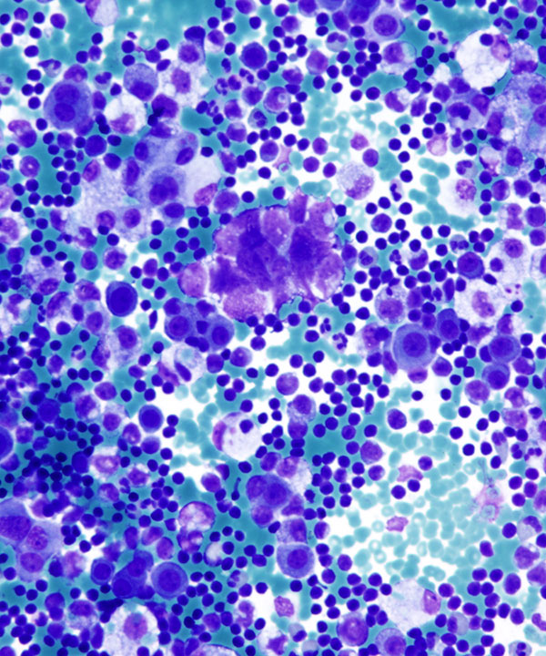 02 : Fluids Metastatic Small Cell Carcinoma