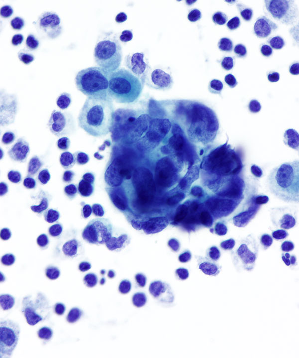 03 : Fluids Metastatic Small Cell Carcinoma