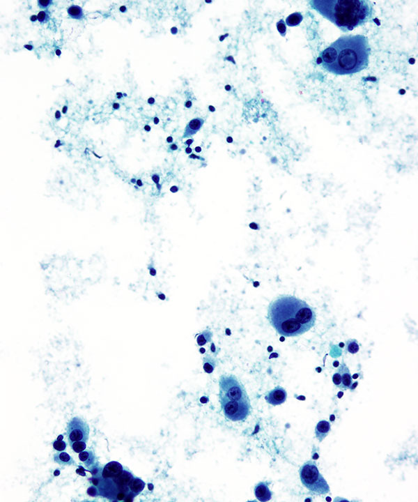 03 : Fluids Metastatic Melanoma