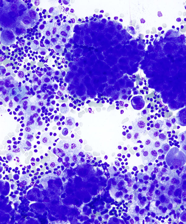 02 : Fluids Mesothelioma