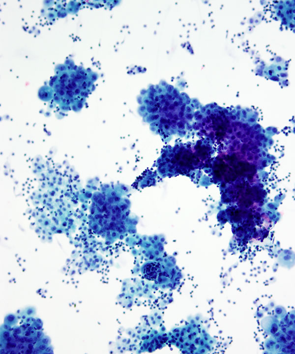 04 : Fluids Mesothelioma