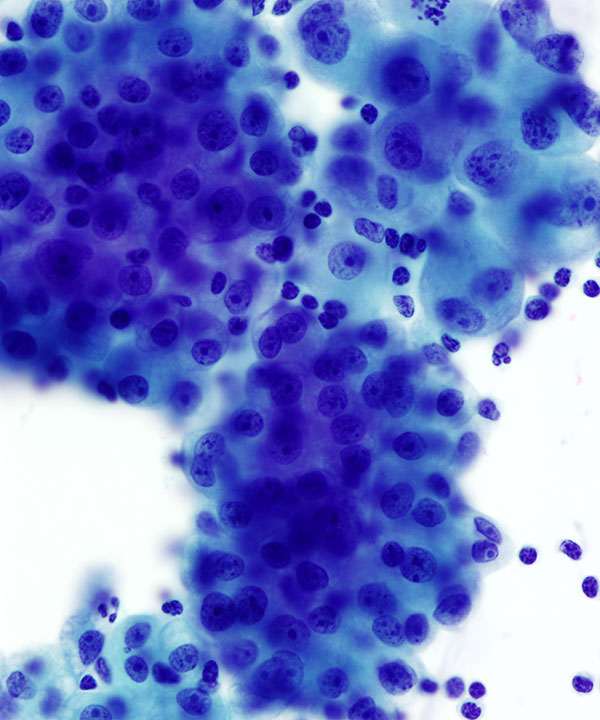 05 : Fluids Mesothelioma