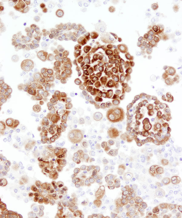 09 : Fluids Mesothelioma