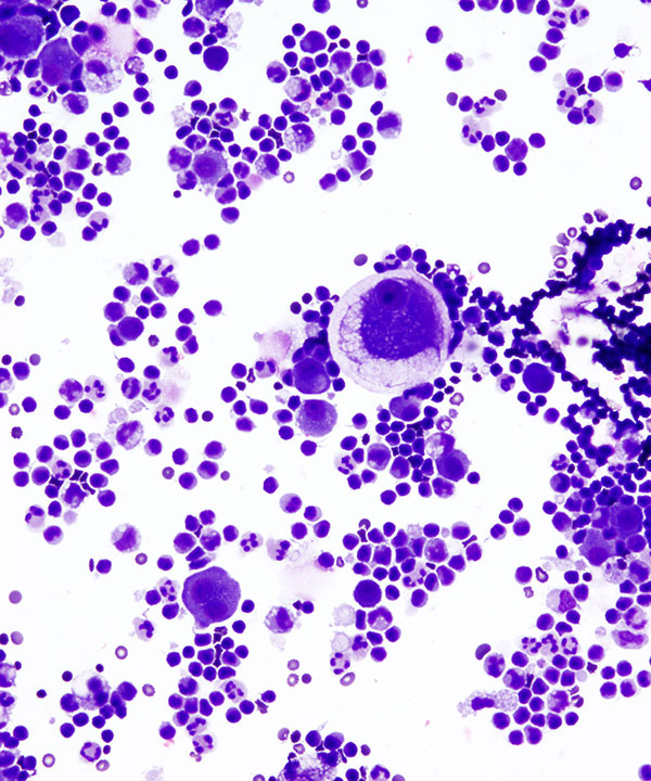 image showing 'Metastatic Renal Cell Carcinoma'