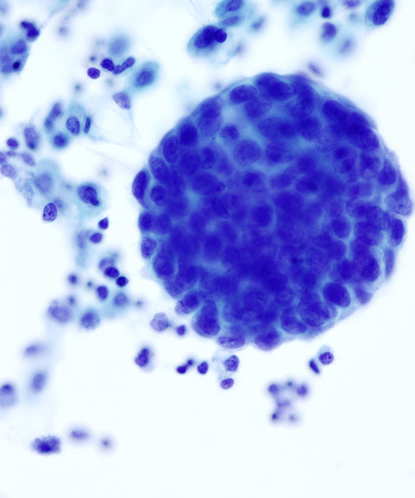 03 : Fluids Metastatic Breast Carcinoma