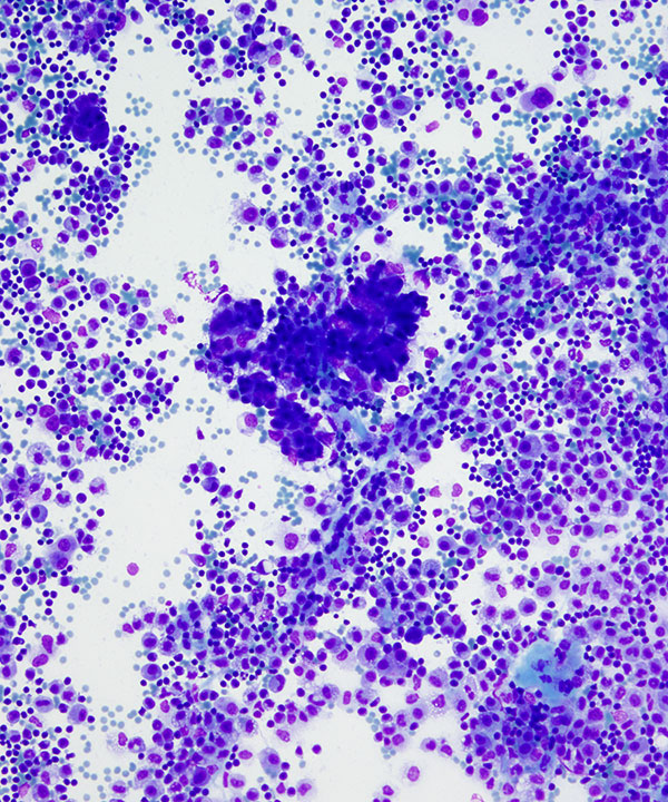 image showing 'Metastatic Serous Carcinoma'