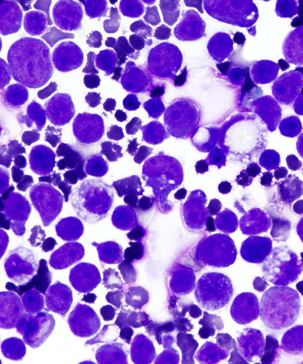 04 : Fluids Prim Eff Lymphoma