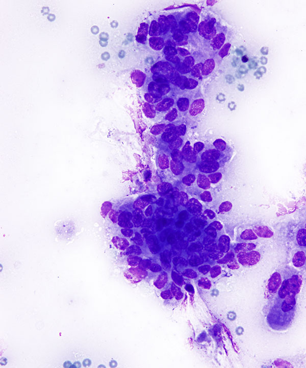 02 : Gastrointestinal Tract Ampullary Adenocarcinoma