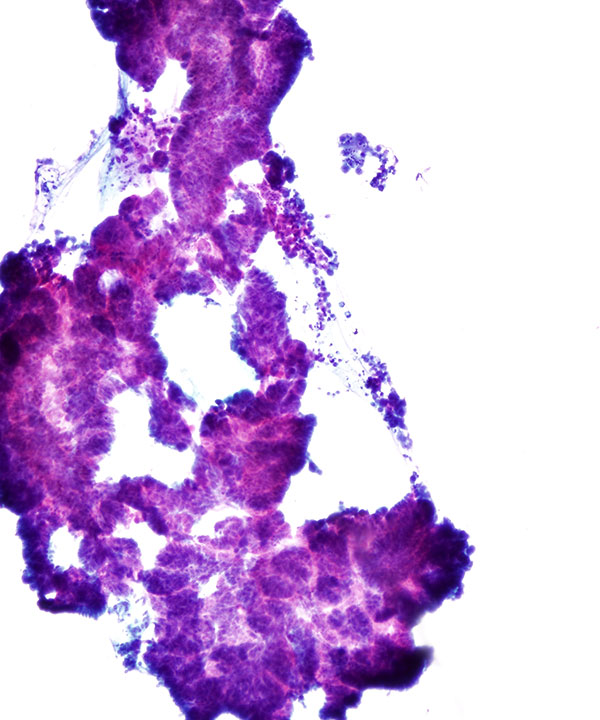 03 : Gastrointestinal Tract Ampullary Adenocarcinoma