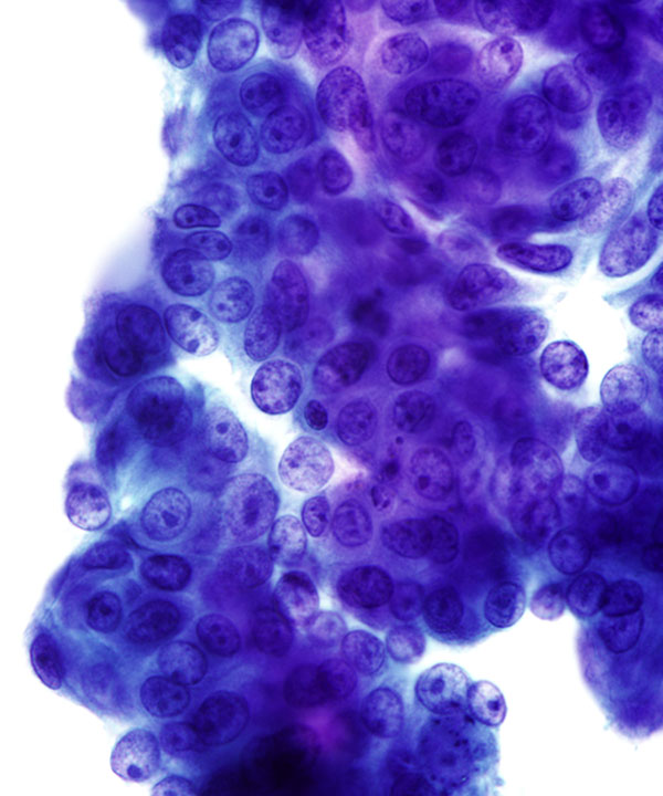 06 : Gastrointestinal Tract Ampullary Adenocarcinoma