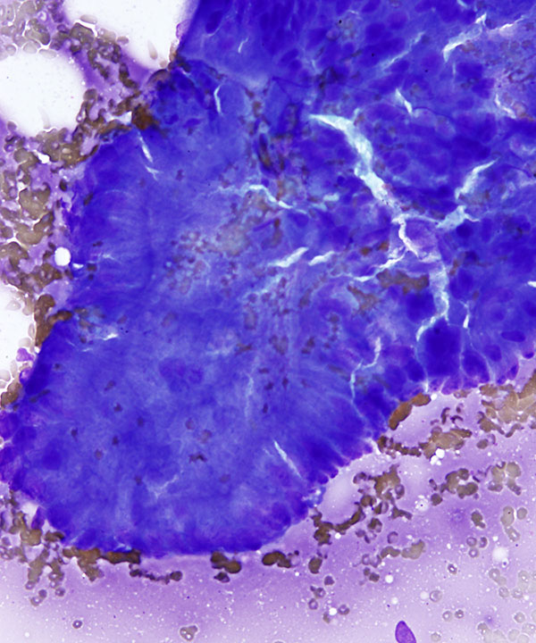 02 : GI Tract Colorectal Adenocarcinoma