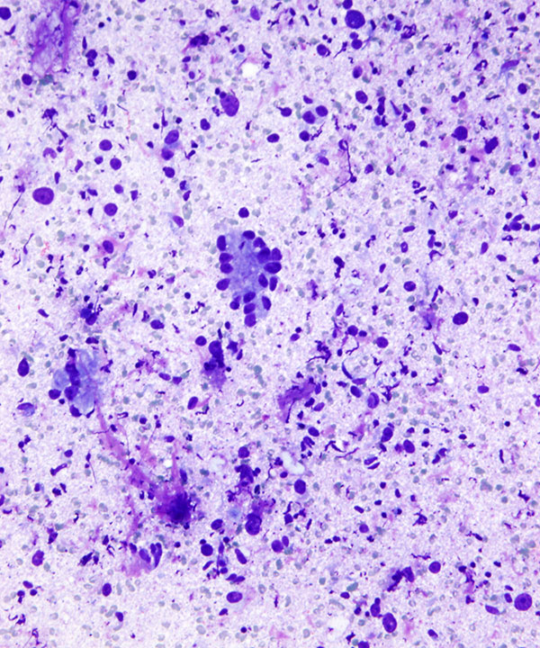 image showing 'Esophageal Adenocarcinoma'