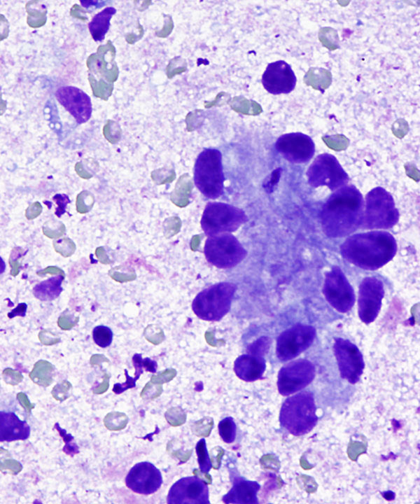 02 : GI Esophageal Adenocarcinoma