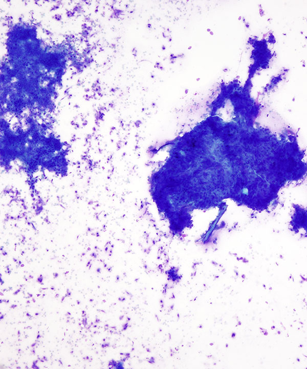 image showing 'Esophageal Squamous cell Carcinoma'